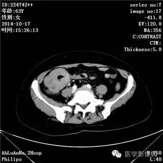 【病例】小肠淋巴瘤1例CT影像表现 【病例】小肠淋巴瘤1例CT影像表现