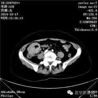 【病例】小肠淋巴瘤1例CT影像表现 【病例】小肠淋巴瘤1例CT影像表现