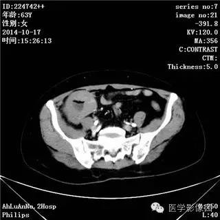 【病例】小肠淋巴瘤1例CT影像表现 【病例】小肠淋巴瘤1例CT影像表现