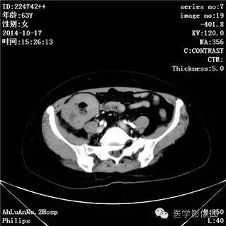【病例】小肠淋巴瘤1例CT影像表现 【病例】小肠淋巴瘤1例CT影像表现