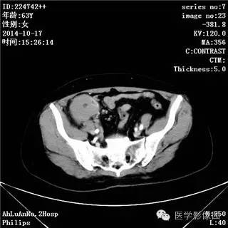 【病例】小肠淋巴瘤1例CT影像表现 【病例】小肠淋巴瘤1例CT影像表现