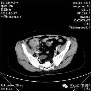 【病例】小肠淋巴瘤1例CT影像表现 【病例】小肠淋巴瘤1例CT影像表现