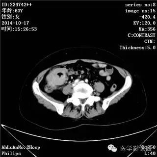 【病例】小肠淋巴瘤1例CT影像表现 【病例】小肠淋巴瘤1例CT影像表现
