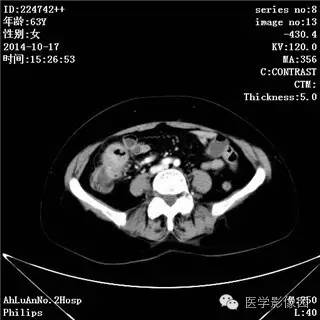 【病例】小肠淋巴瘤1例CT影像表现 【病例】小肠淋巴瘤1例CT影像表现