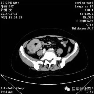 【病例】小肠淋巴瘤1例CT影像表现 【病例】小肠淋巴瘤1例CT影像表现