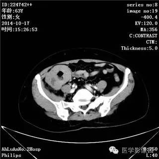 【病例】小肠淋巴瘤1例CT影像表现 【病例】小肠淋巴瘤1例CT影像表现
