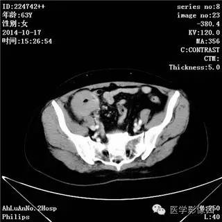 【病例】小肠淋巴瘤1例CT影像表现 【病例】小肠淋巴瘤1例CT影像表现