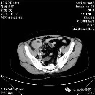 【病例】小肠淋巴瘤1例CT影像表现 【病例】小肠淋巴瘤1例CT影像表现