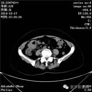 【病例】小肠淋巴瘤1例CT影像表现 【病例】小肠淋巴瘤1例CT影像表现