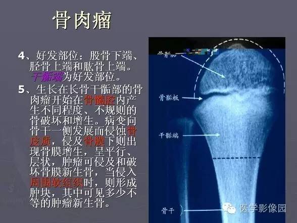 【PPT】骨肉瘤的X线诊断