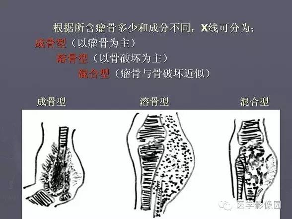 【PPT】骨肉瘤的X线诊断