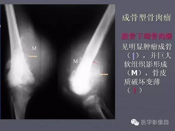 【PPT】骨肉瘤的X线诊断