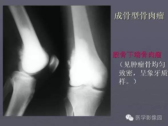 【PPT】骨肉瘤的X线诊断