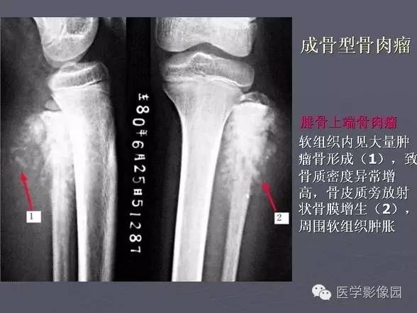 【PPT】骨肉瘤的X线诊断