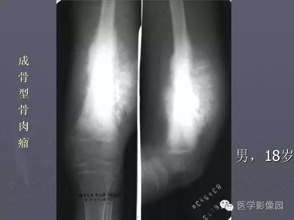 【PPT】骨肉瘤的X线诊断