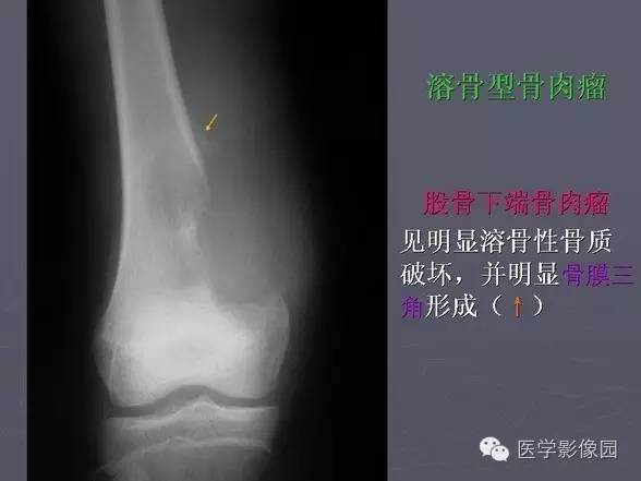 【PPT】骨肉瘤的X线诊断