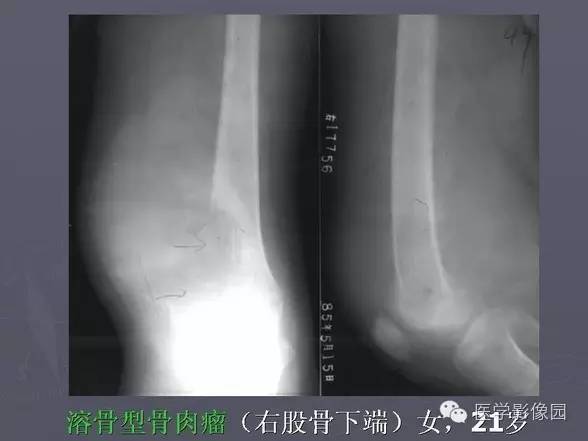 【PPT】骨肉瘤的X线诊断