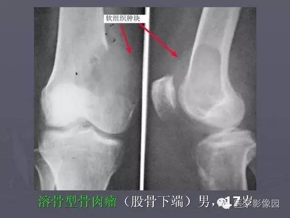 【PPT】骨肉瘤的X线诊断