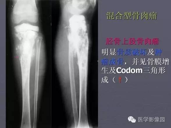 【PPT】骨肉瘤的X线诊断