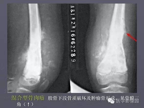 【PPT】骨肉瘤的X线诊断