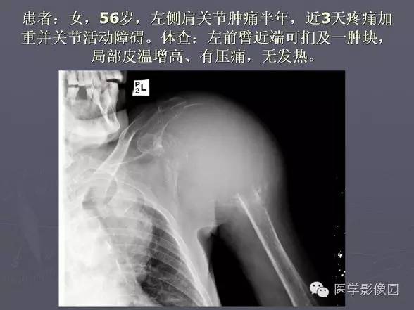 【PPT】骨肉瘤的X线诊断