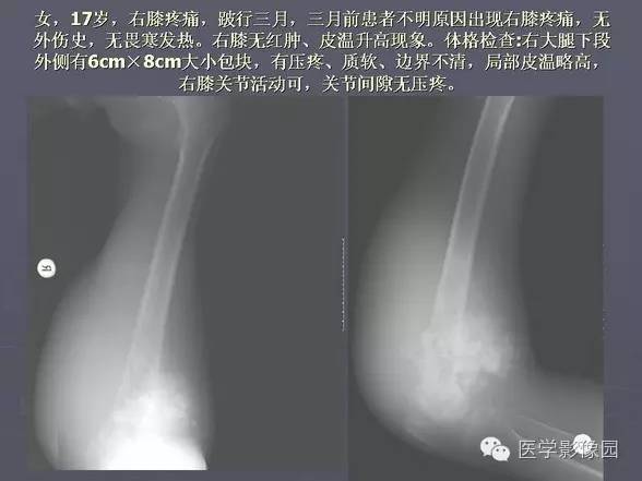 【PPT】骨肉瘤的X线诊断