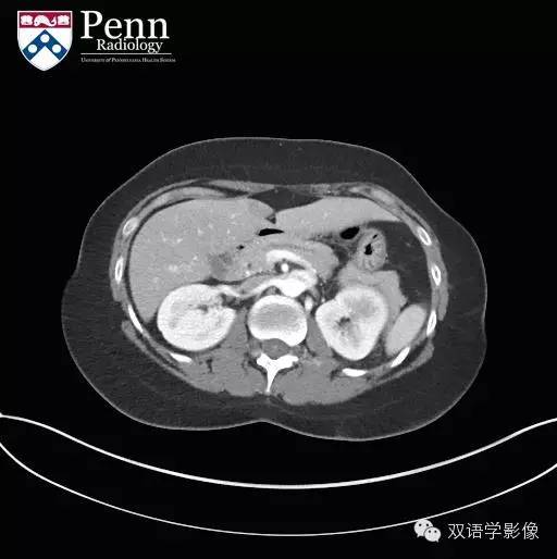 【双语病例】Pancreas divisum胰腺分裂