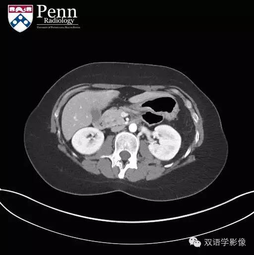 【双语病例】Pancreas divisum胰腺分裂