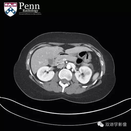 【双语病例】Pancreas divisum胰腺分裂