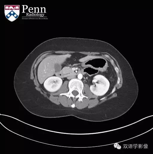 【双语病例】Pancreas divisum胰腺分裂