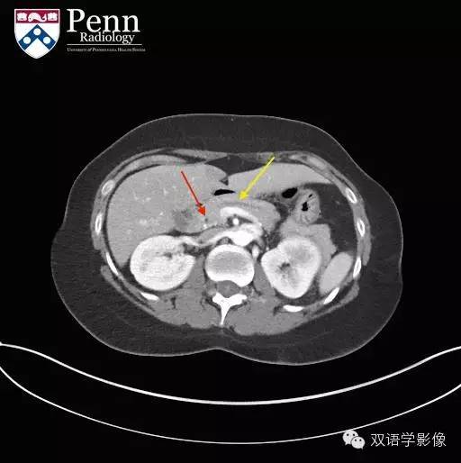 【双语病例】Pancreas divisum胰腺分裂