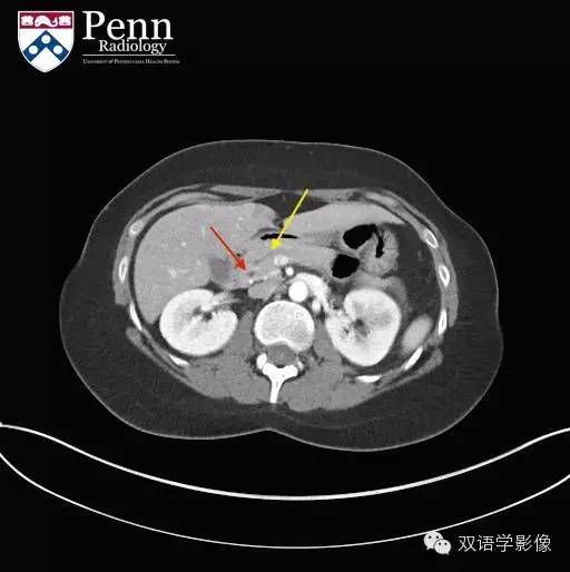 【双语病例】Pancreas divisum胰腺分裂