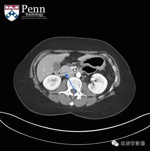 【双语病例】Pancreas divisum胰腺分裂
