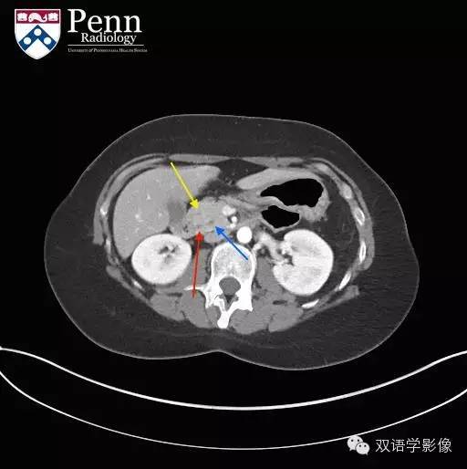 【双语病例】Pancreas divisum胰腺分裂