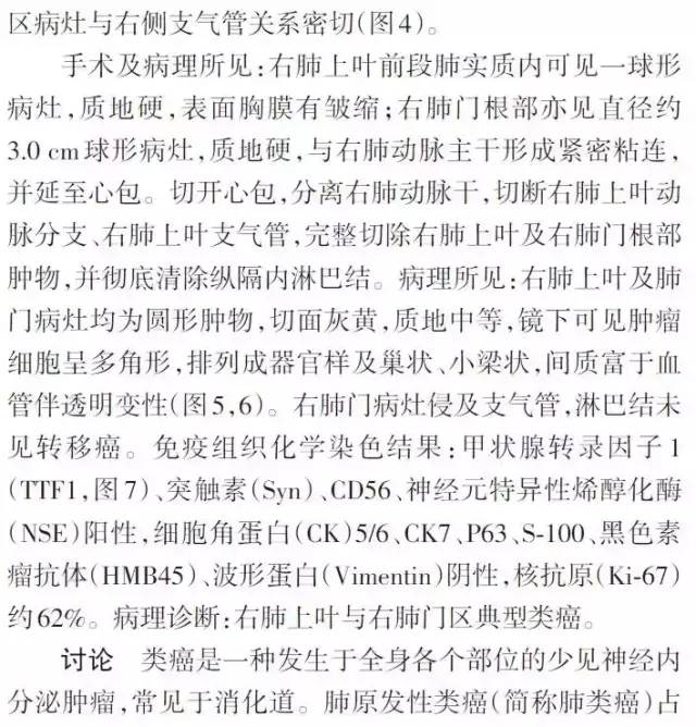 【病例】双原发性右肺典型类癌一例