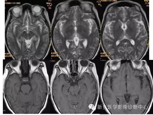 【病例】Wernicke脑病1例MR影像表现