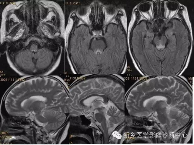 【病例】Wernicke脑病1例MR影像表现