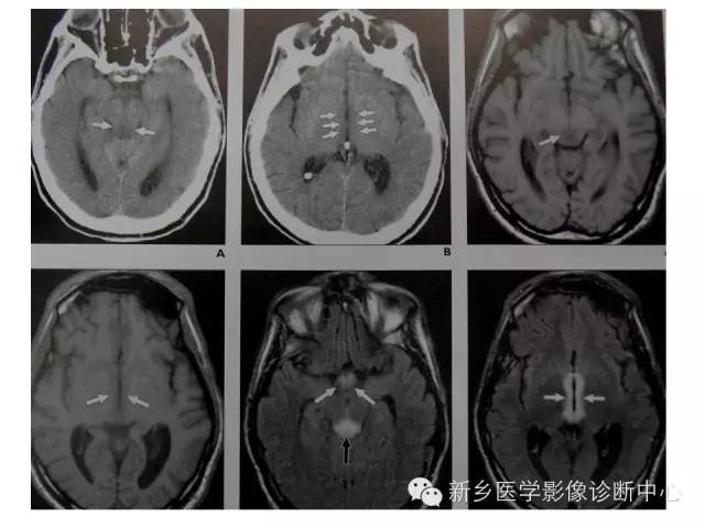 【病例】Wernicke脑病1例MR影像表现