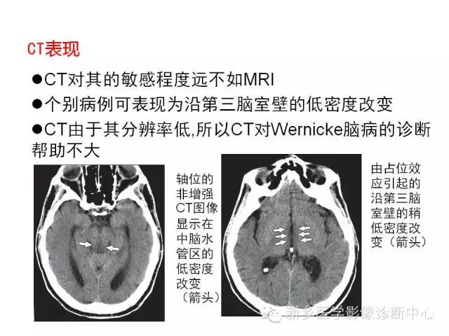 【病例】Wernicke脑病1例MR影像表现