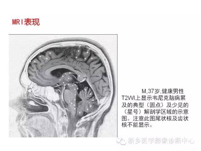 【病例】Wernicke脑病1例MR影像表现