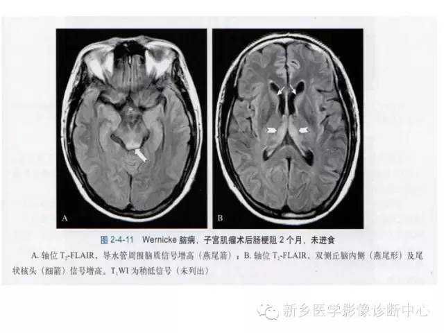 【病例】Wernicke脑病1例MR影像表现