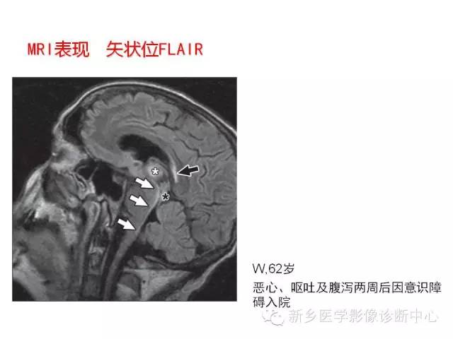 【病例】Wernicke脑病1例MR影像表现