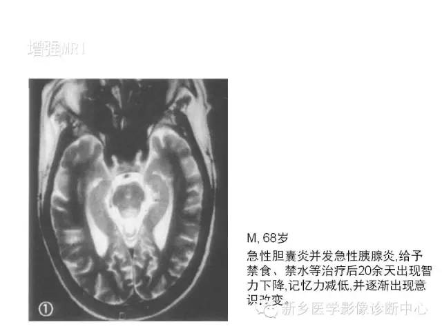【病例】Wernicke脑病1例MR影像表现