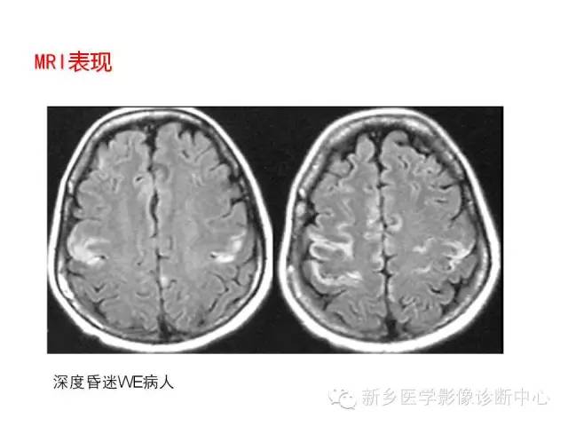 【病例】Wernicke脑病1例MR影像表现