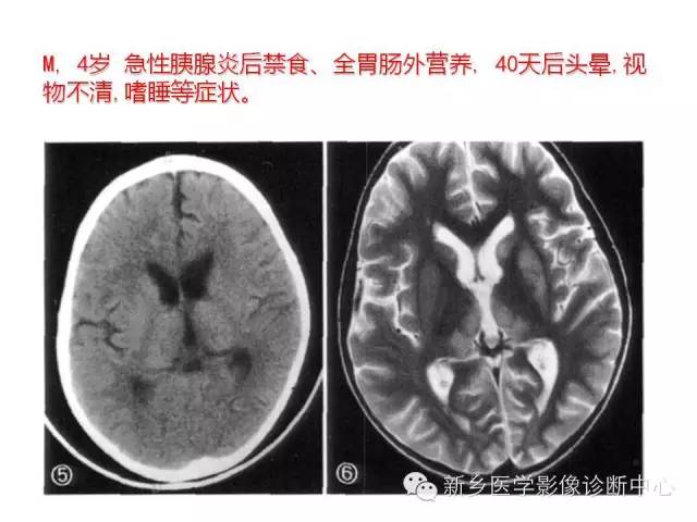 【病例】Wernicke脑病1例MR影像表现