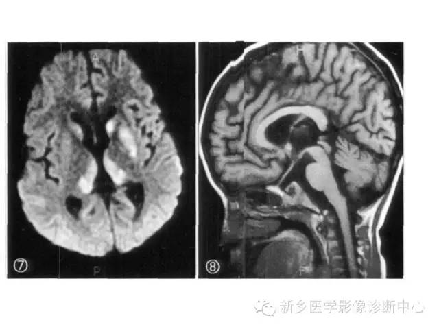 【病例】Wernicke脑病1例MR影像表现