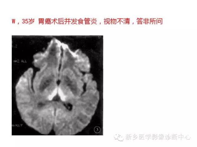 【病例】Wernicke脑病1例MR影像表现