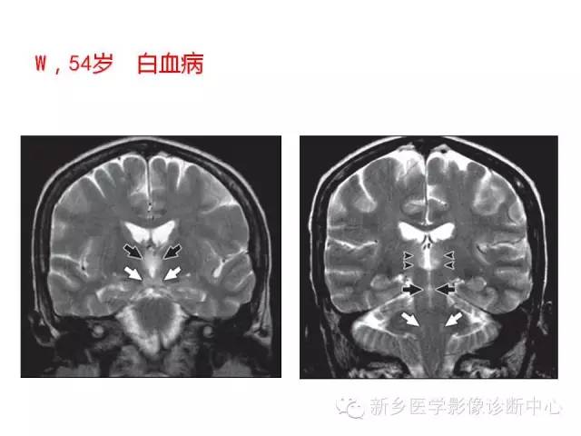 【病例】Wernicke脑病1例MR影像表现