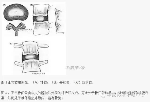 椎间盘膨出、突出、变性图解
