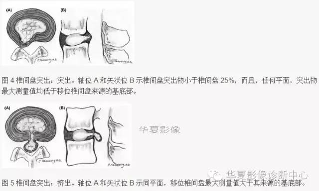 椎间盘膨出、突出、变性图解